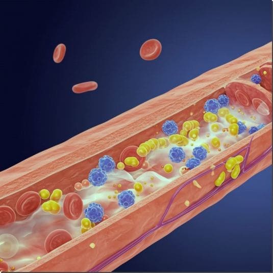 중성지방이 높으면 생기는 증상
