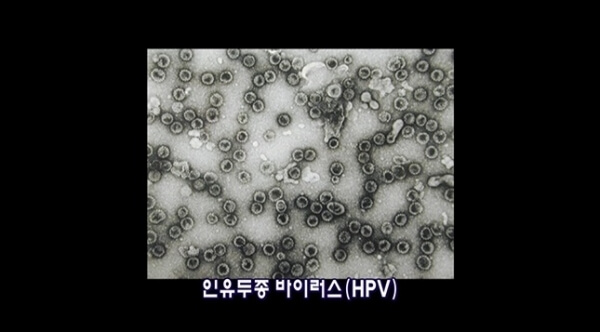 인유두종바이러스