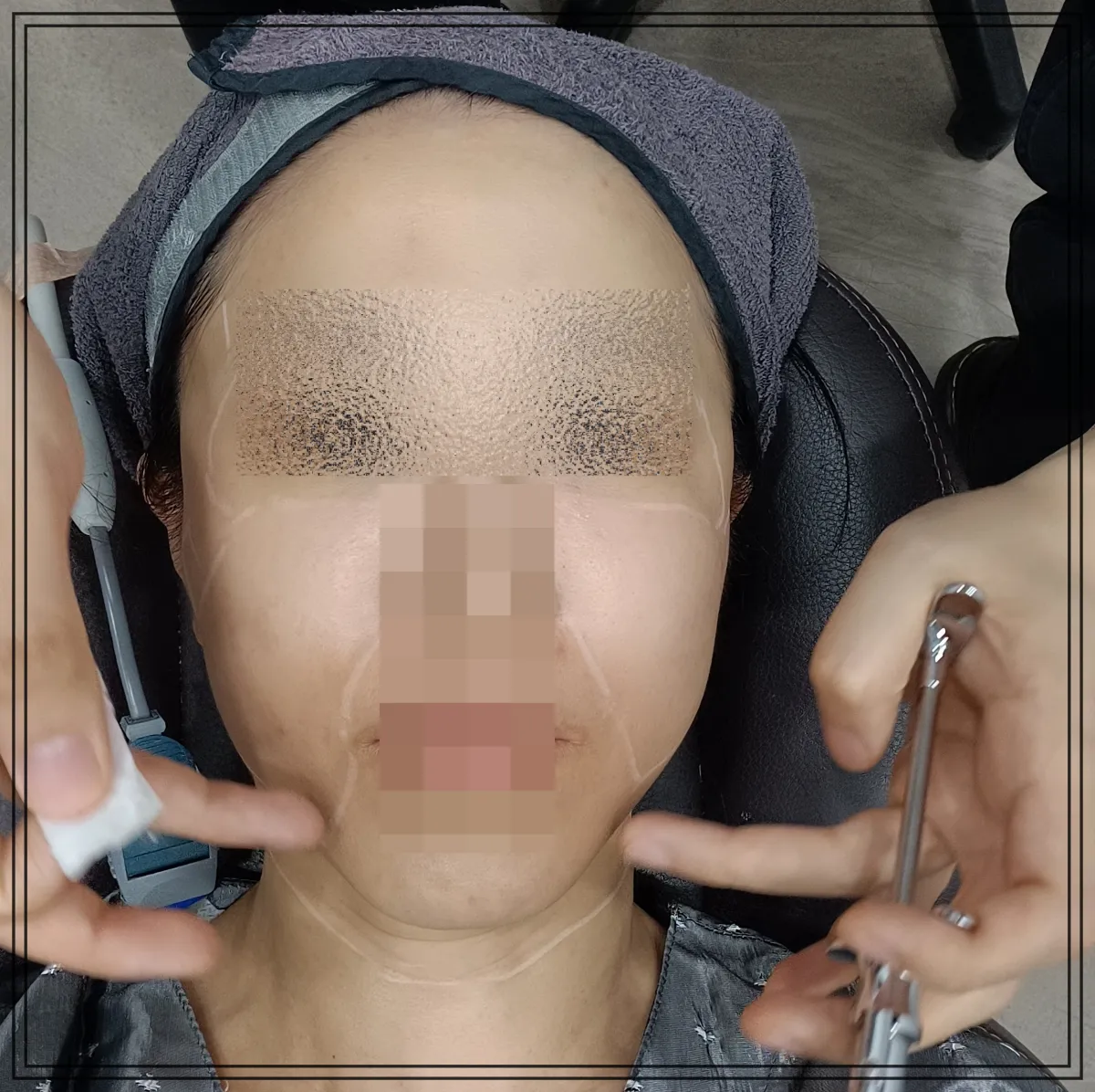 써마지-flx-주사마취