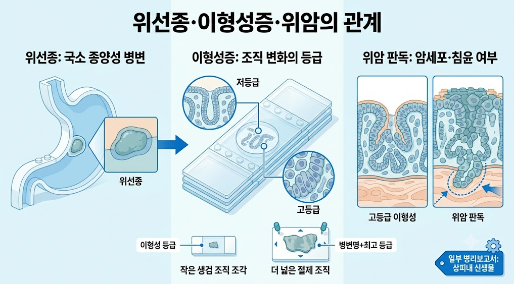 위선종과 이형성증, 위암 판단에서 병변명&middot;조직 변화 등급&middot;암세포 침윤 여부를 구분하는 설명 이미지