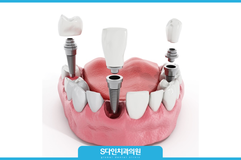 무절개 임플란트