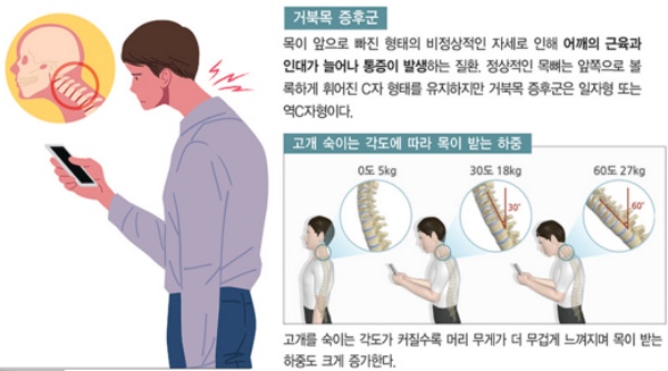 팔 저림이 있을때 거북목의 연관성
