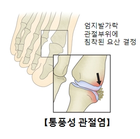 통풍