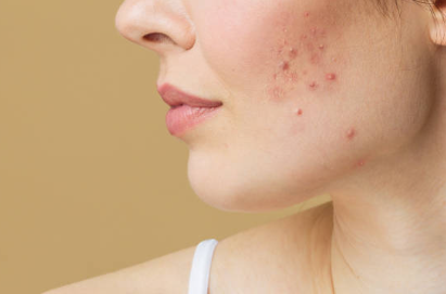 여드름 흉터