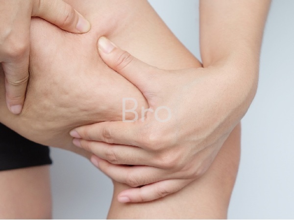 허벅지 셀룰라이트를 잡은 사진 1