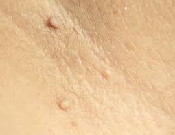 비립종 없애는 방법