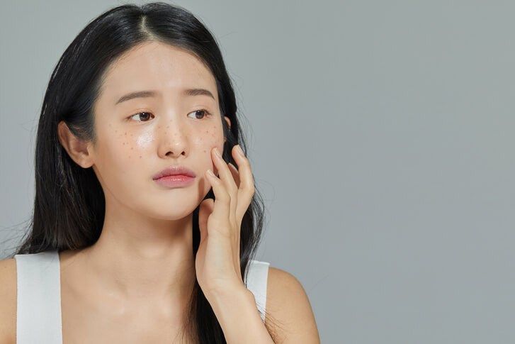 피부에 잡티가 많은 여성
