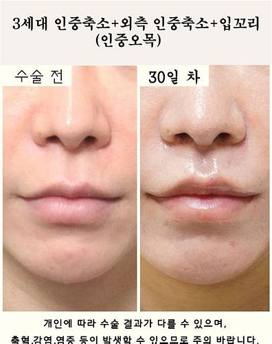 인중 축소 수술
