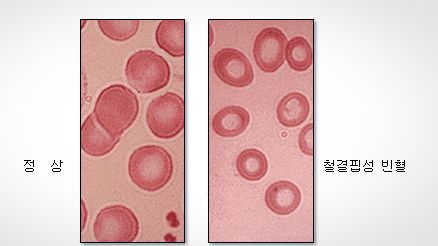 빈혈 수치가 낮으면