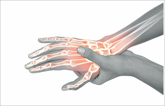 류마티스 관절염 초기증상