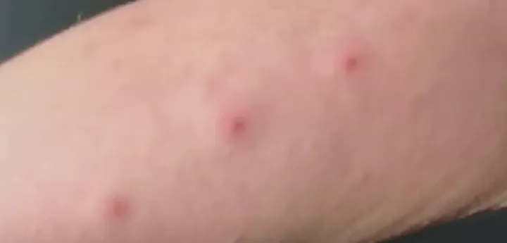 빈대 물린 자국