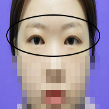 이마거상술 후 사진 예시