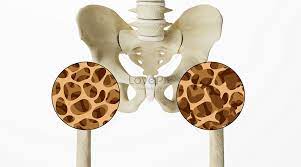 골밀도 검사수치