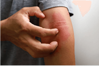 피부염 가려움