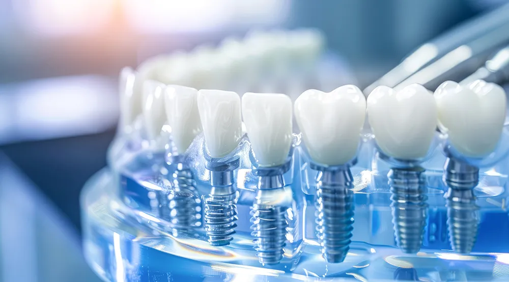 전체 임플란트 가격