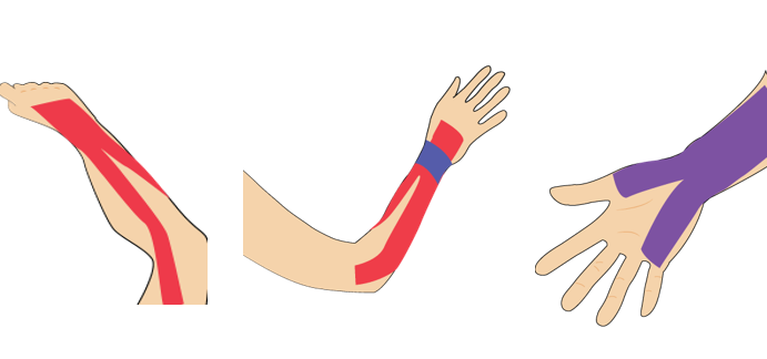 간(건)글리온을 동반한 손목 위쪽 통증