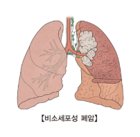 폐암의 이미지