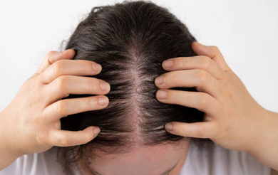 여성 탈모 원인