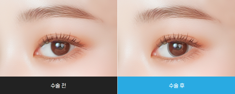 아이링 수술, 눈동자 성형, 아이링 수술 가격, 아이링 수술 부작용, 아이링 수술 후기, 아이링 수술 전후 사진, 아이링 수술 회복 기간, 서클렌즈 대체 성형, 눈동자 확대 수술