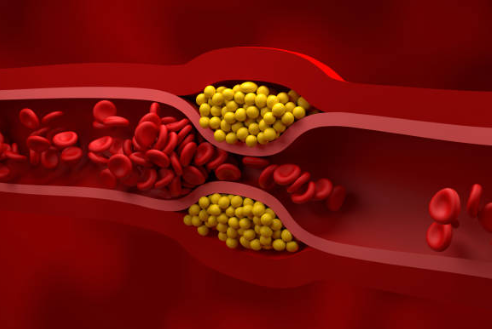 중성지방 정상수치
