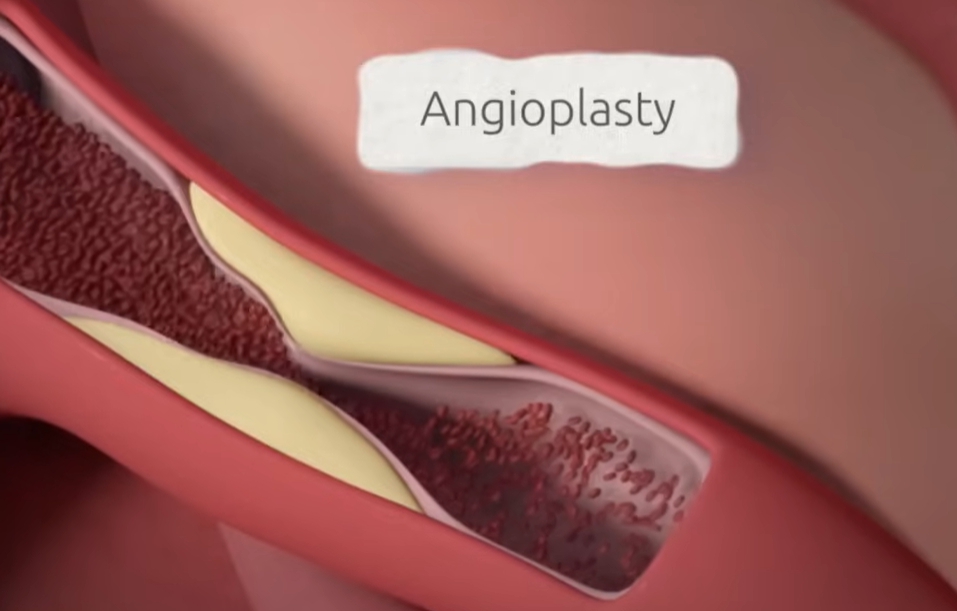 관상동맥 조영술