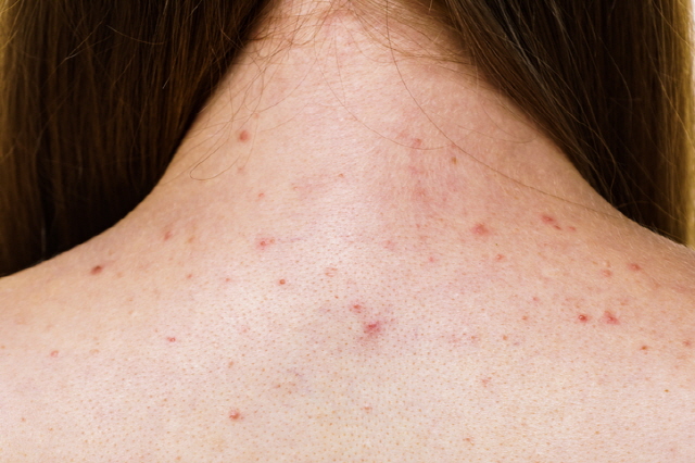 가드름 등드름 원인과 없애는 방법(시술X)