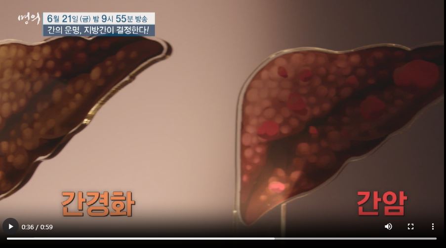 명의 지방간 원인 예방