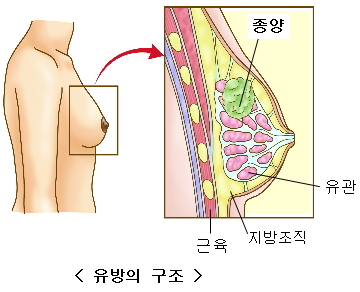 유방암