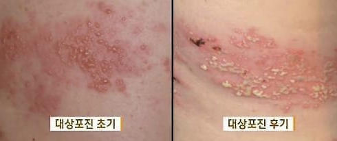 대상포진 초기, 후기 이미지