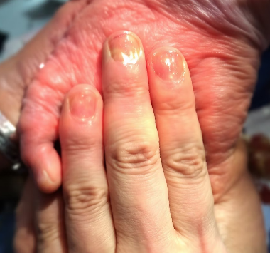 바이러스 감염 후 관절통? 류마티스 의심해야 할까