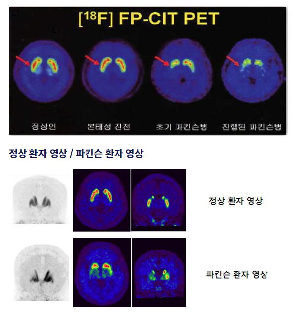 Brain PET-CT(FP-CIT) 파킨슨병 진단을 위한 뇌 영상 검사