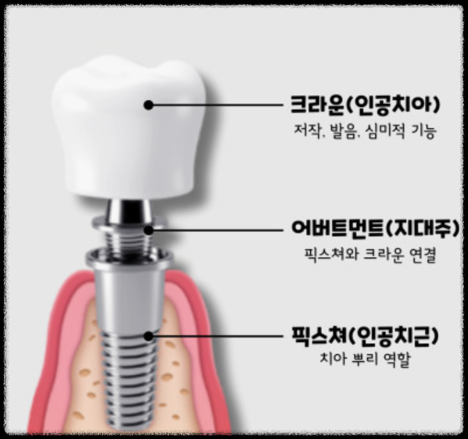 임플란트 구조