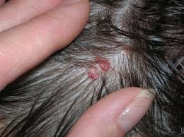 두피 여드름과 헤어라인 트러블 관리 이미지