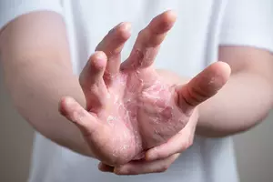 한포진-치료방법