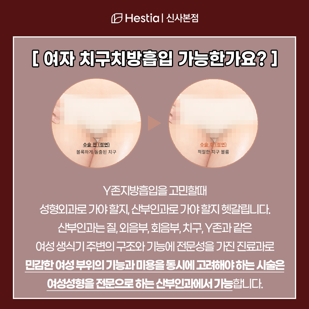 Y존지방흡입도 되나요??