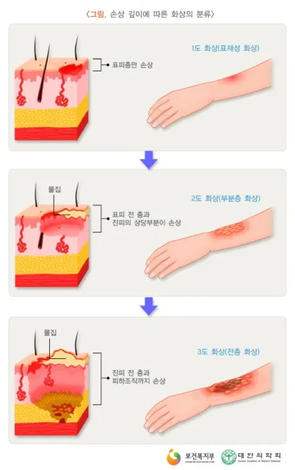 2도 화상 증상 자가치료 회복기간 응급처치법 정리_1