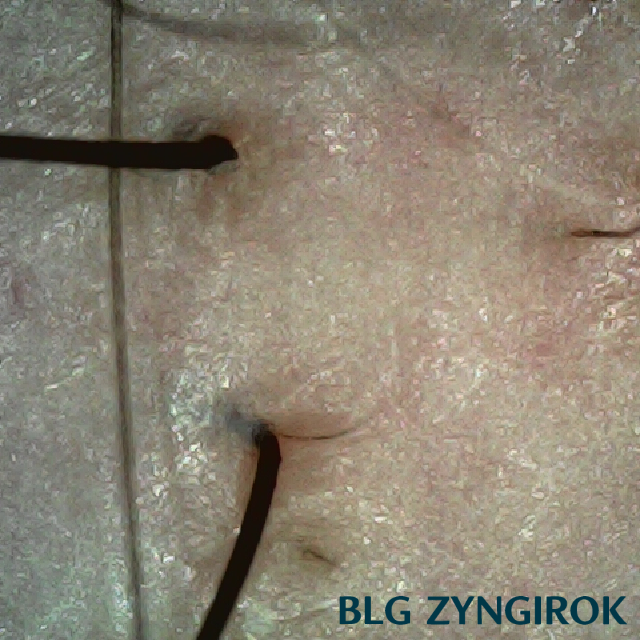 피나모아 복용 8주차 두피사진 - 오른쪽 M자 부위 모습이다.