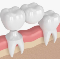 크라운치료-사진7
