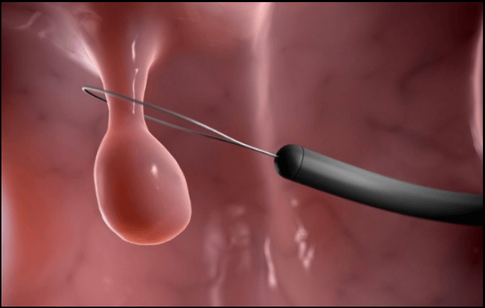 대장암(대변검사)검진-무료-검진기관찾기-조회방법안내