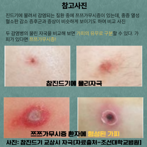 진드기에 물린 자국