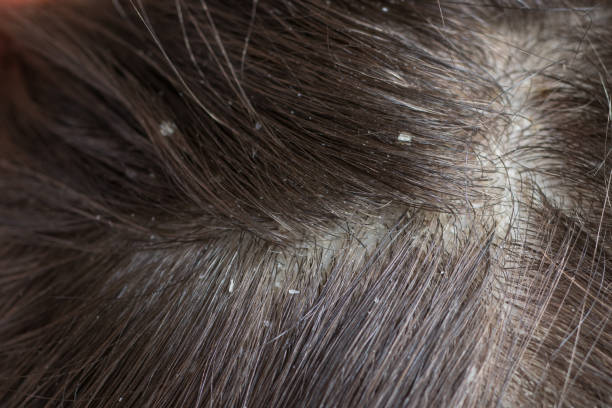 비듬 증상을 악화시키는 요인