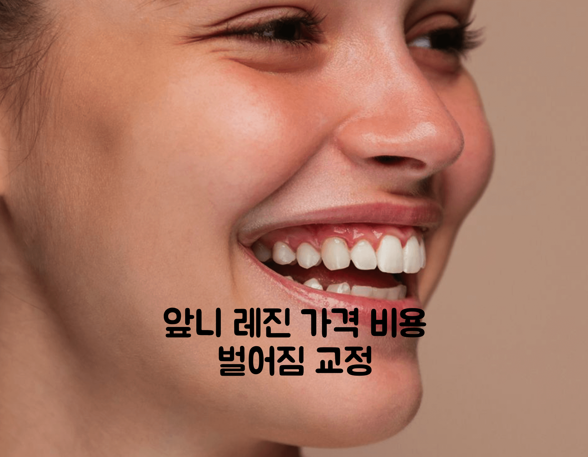 앞니 레진
