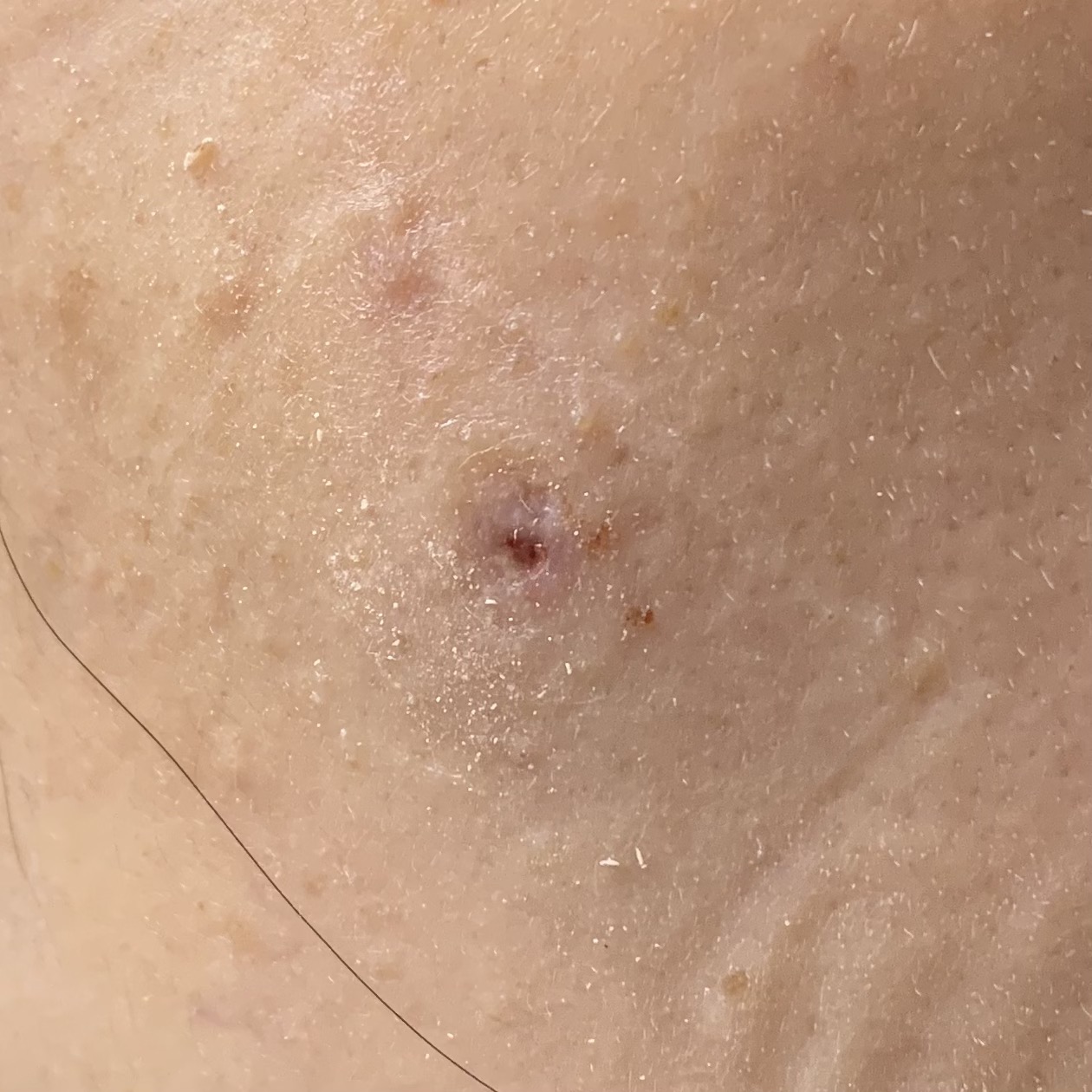 피지낭종 수술2일차