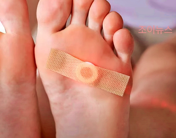 티눈 자가치료로 많이 사용하는 살리실산 제제