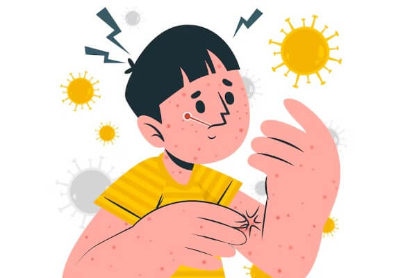 땀띠-원인-증상-없애는-방법-4
