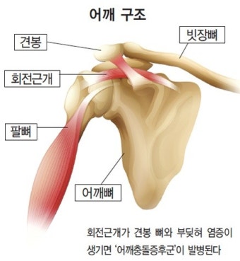  비슷해 보이지만 다른 어깨 통증&amp;#44; 원인과 개선 방법