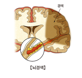 뇌경색-전조증상-5가지-뇌경색-질문답-이-증상이-보이면-병원으로