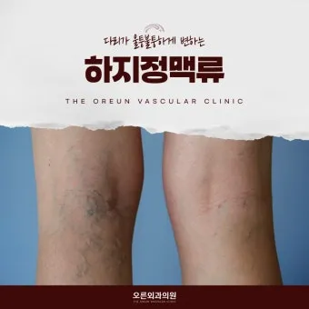 하지 정맥류 증상 치료방법과 예방 생활습관_14