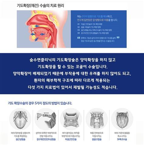 수면무호흡증