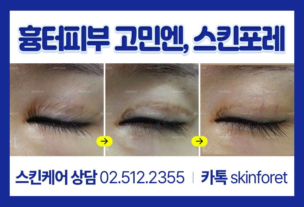 눈세로주름과 몽고주름, 앞트임 후 생긴 세로주름 제거 비포 애프터